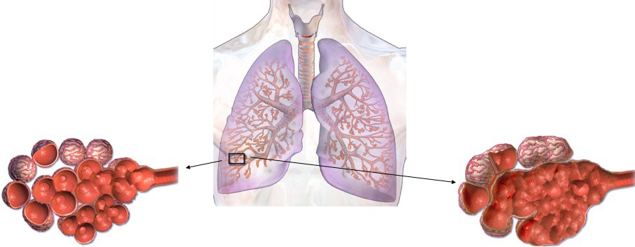 A gene that can damage the lungs | eLife Science Digests | eLife