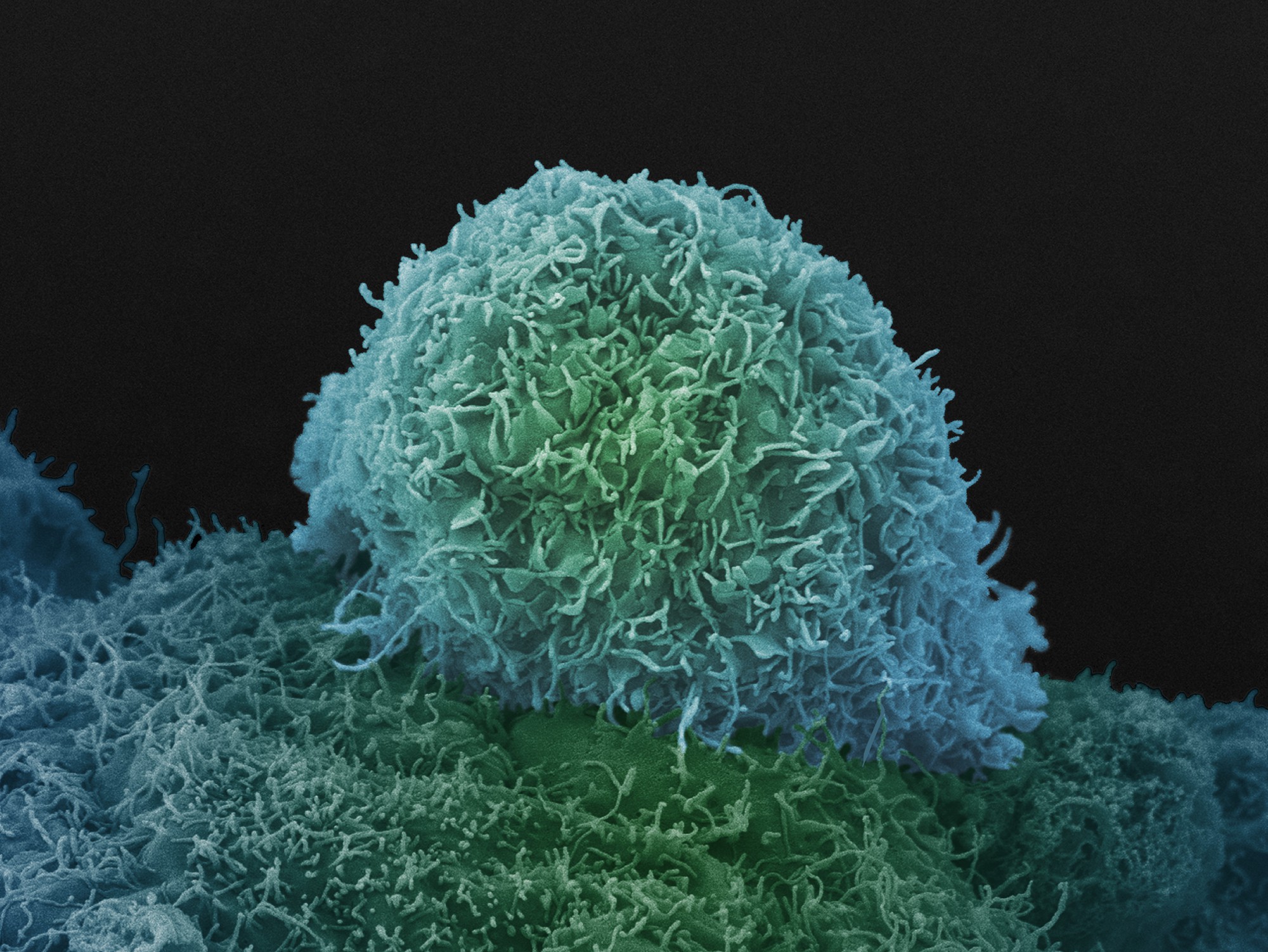 Correct splicing protects against prostate cancer | eLife Science ...