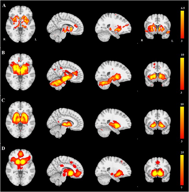 Network structure of brain atrophy in de novo Parkinson's disease | eLife