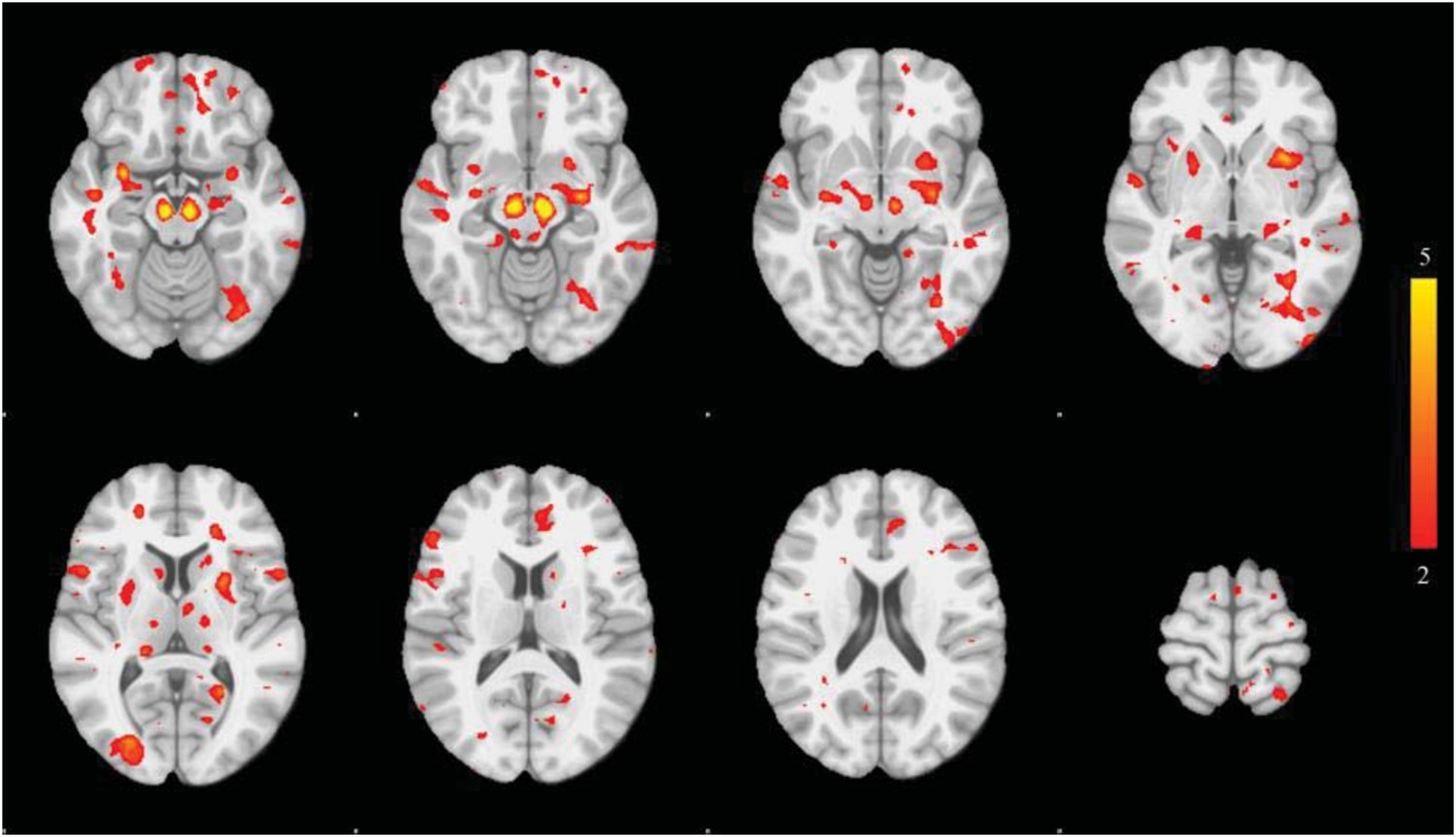 Figures and data in Network structure of brain atrophy in de novo ...