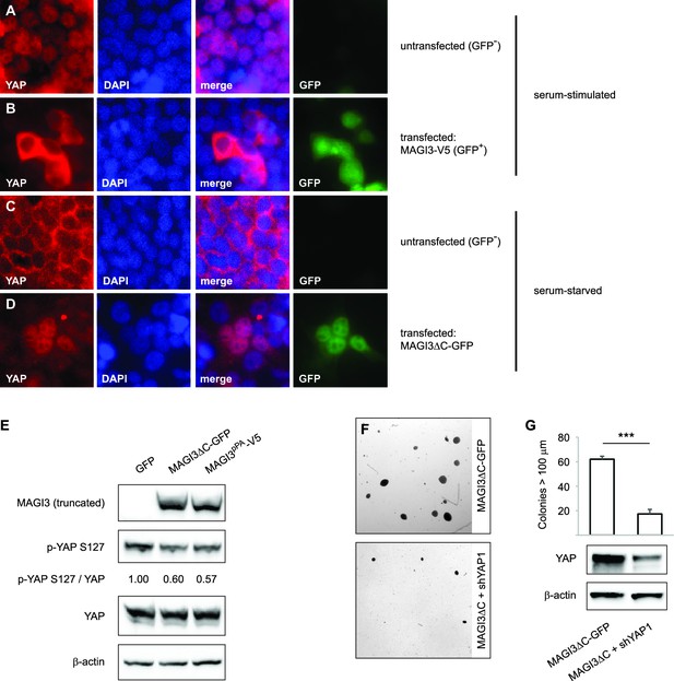 Premature Polyadenylation Of MAGI3 Produces A Dominantly-acting ...