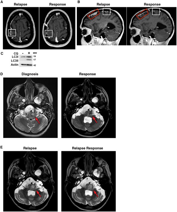 Autophagy inhibition overcomes multiple mechanisms of resistance to ...