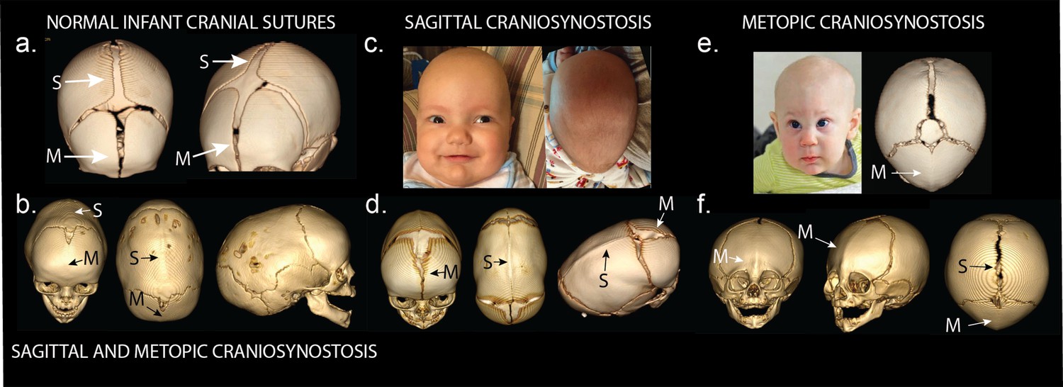 Two Locus Inheritance Of Non-syndromic Midline Craniosynostosis Via ...