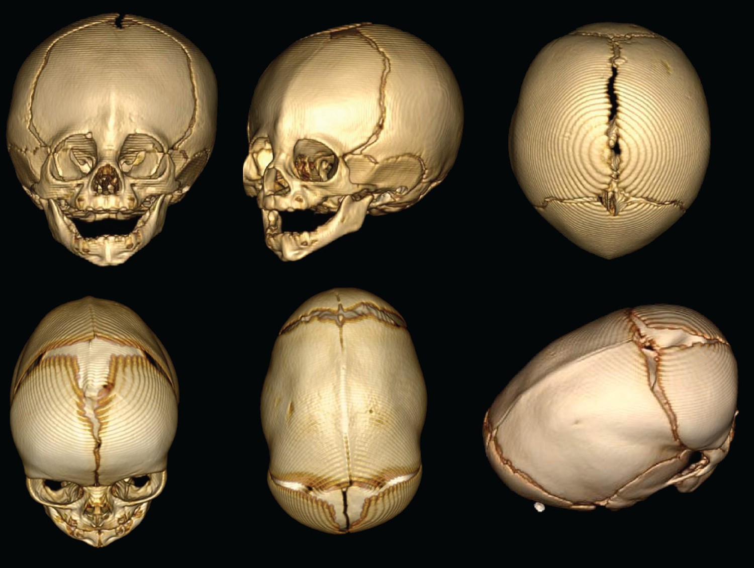 Craniosynostosis An Epistatic Explanation Elife 9798