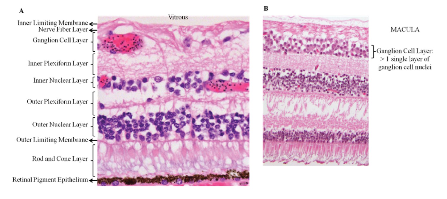 Figures and data in Neurovascular sequestration in paediatric P ...