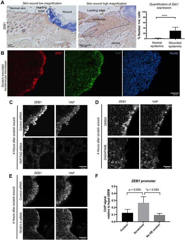 YAP drives cutaneous squamous cell carcinoma formation and progression ...