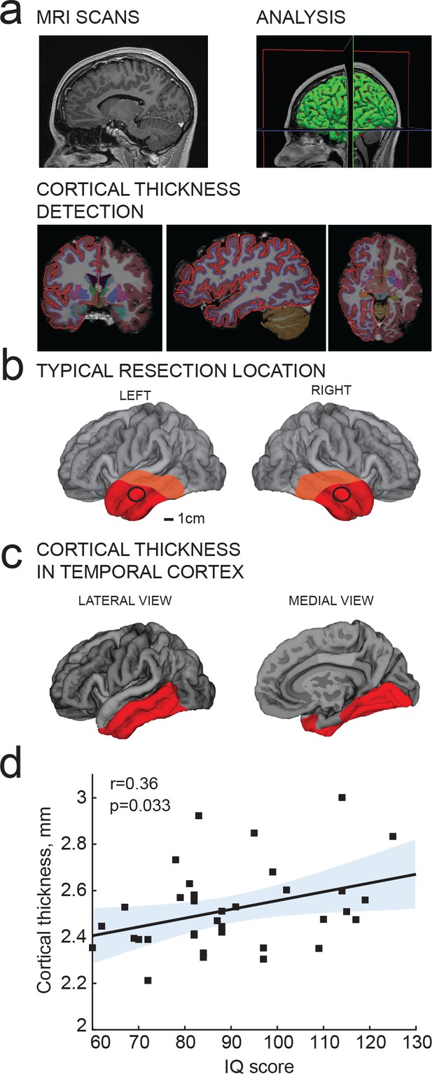 Large And Fast Human Pyramidal Neurons Associate With Intelligence | ELife