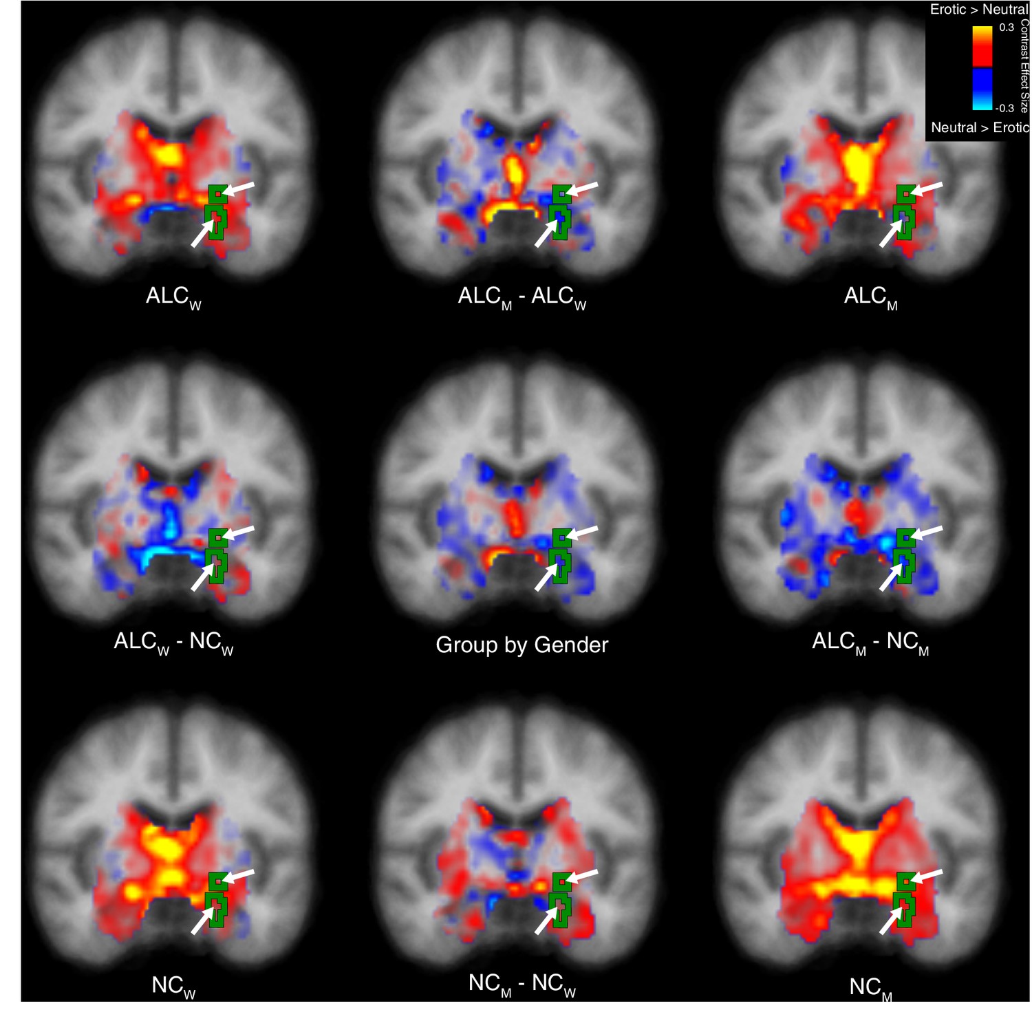 Alcoholism Gender Differences In Brain Responsivity To Emotional