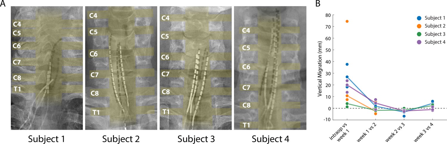 Sensory Restoration By Epidural Stimulation Of The Lateral Spinal Cord ...