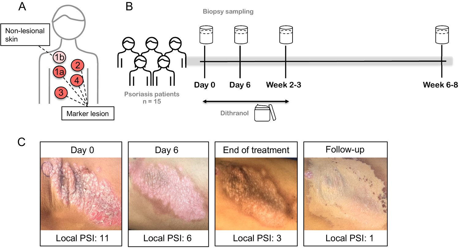 Psoriasis Porn