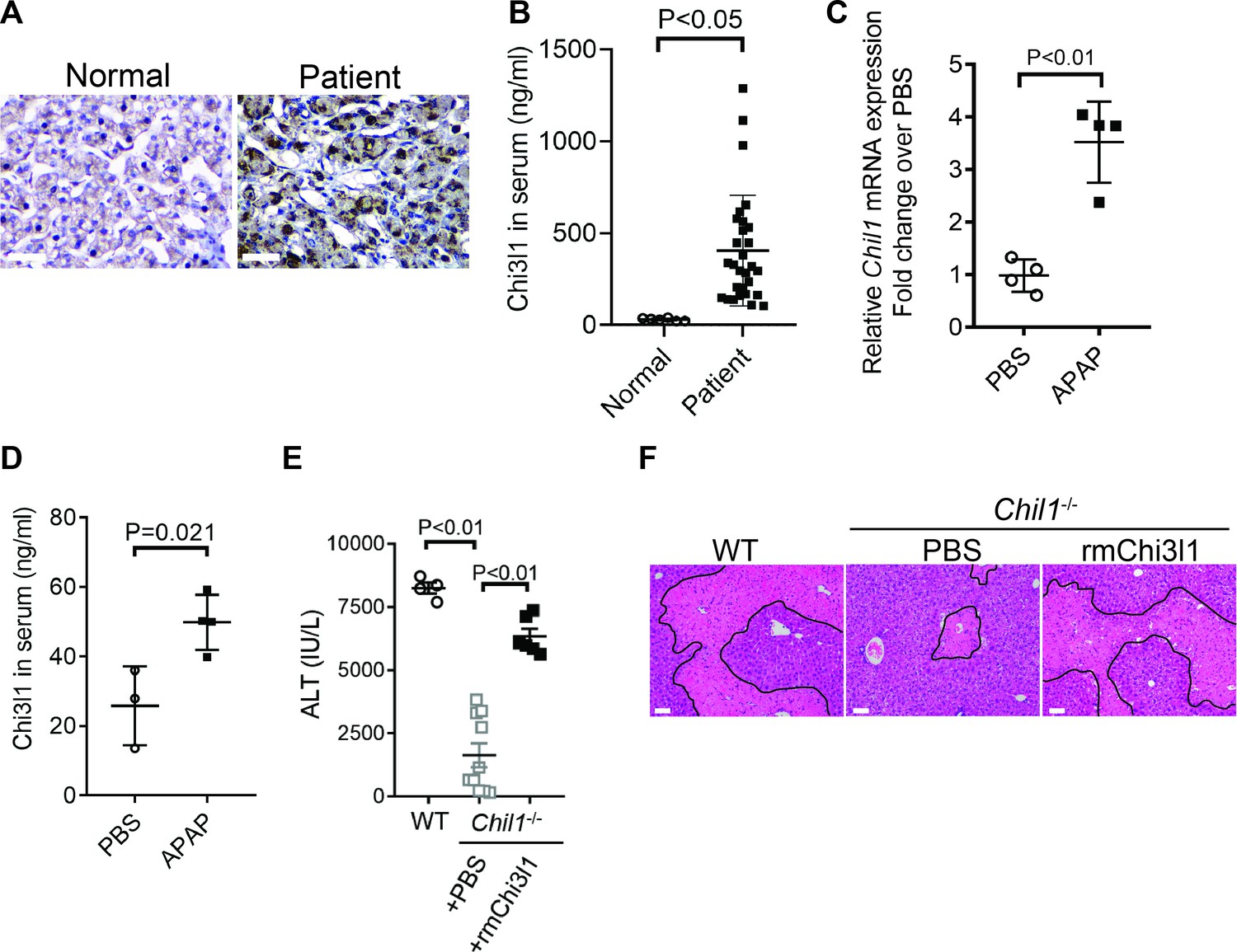 Chitinase 3-like-1 contributes to acetaminophen-induced
