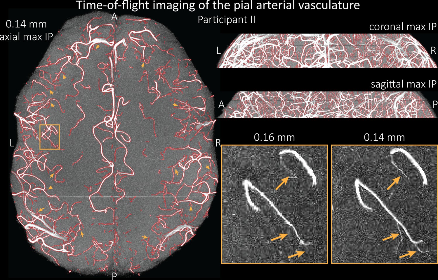 Venous vascular territories of the lateral cerebral cortex (illustration), Radiology Case