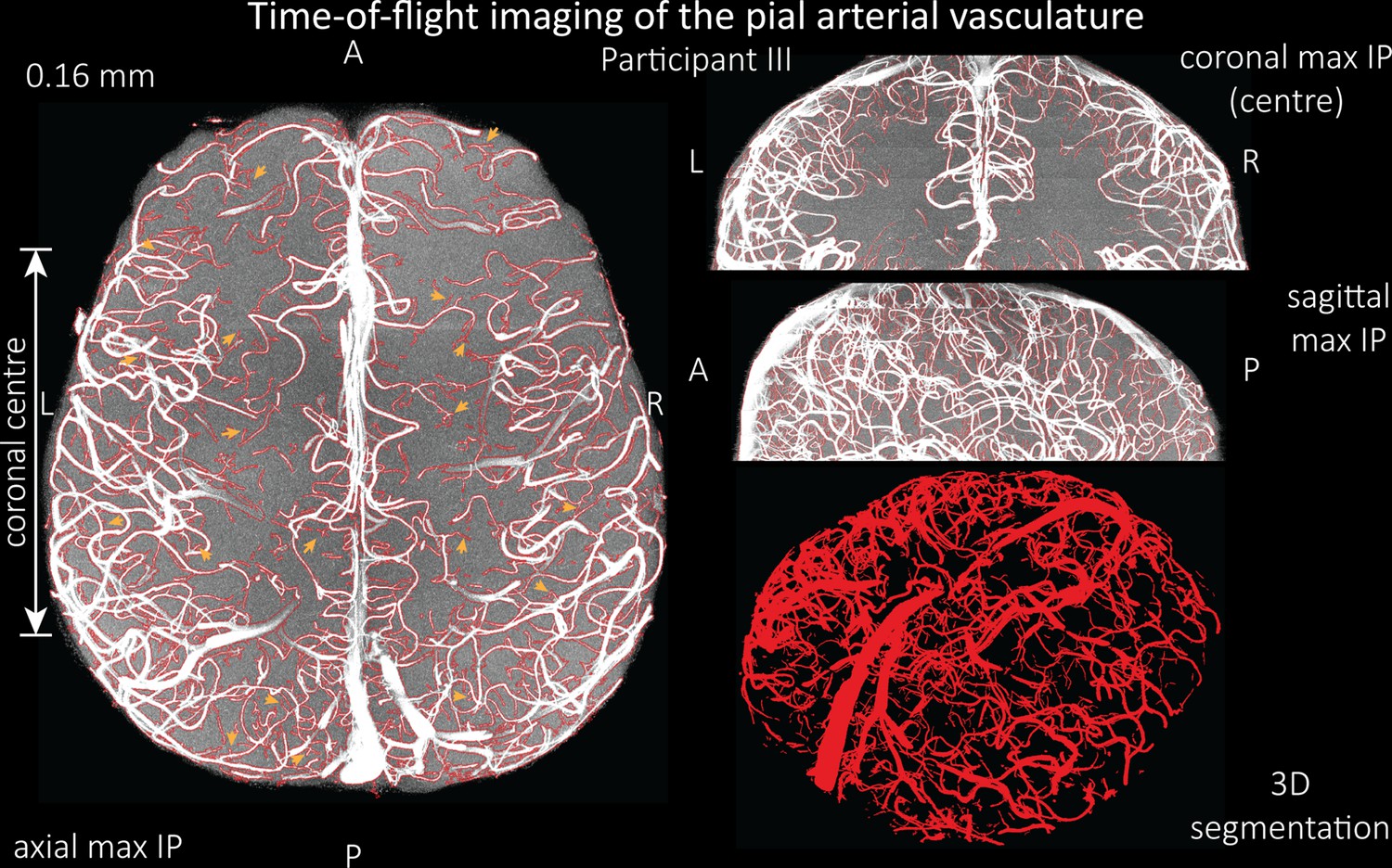 Figures and data in Imaging of the pial arterial vasculature of the ...