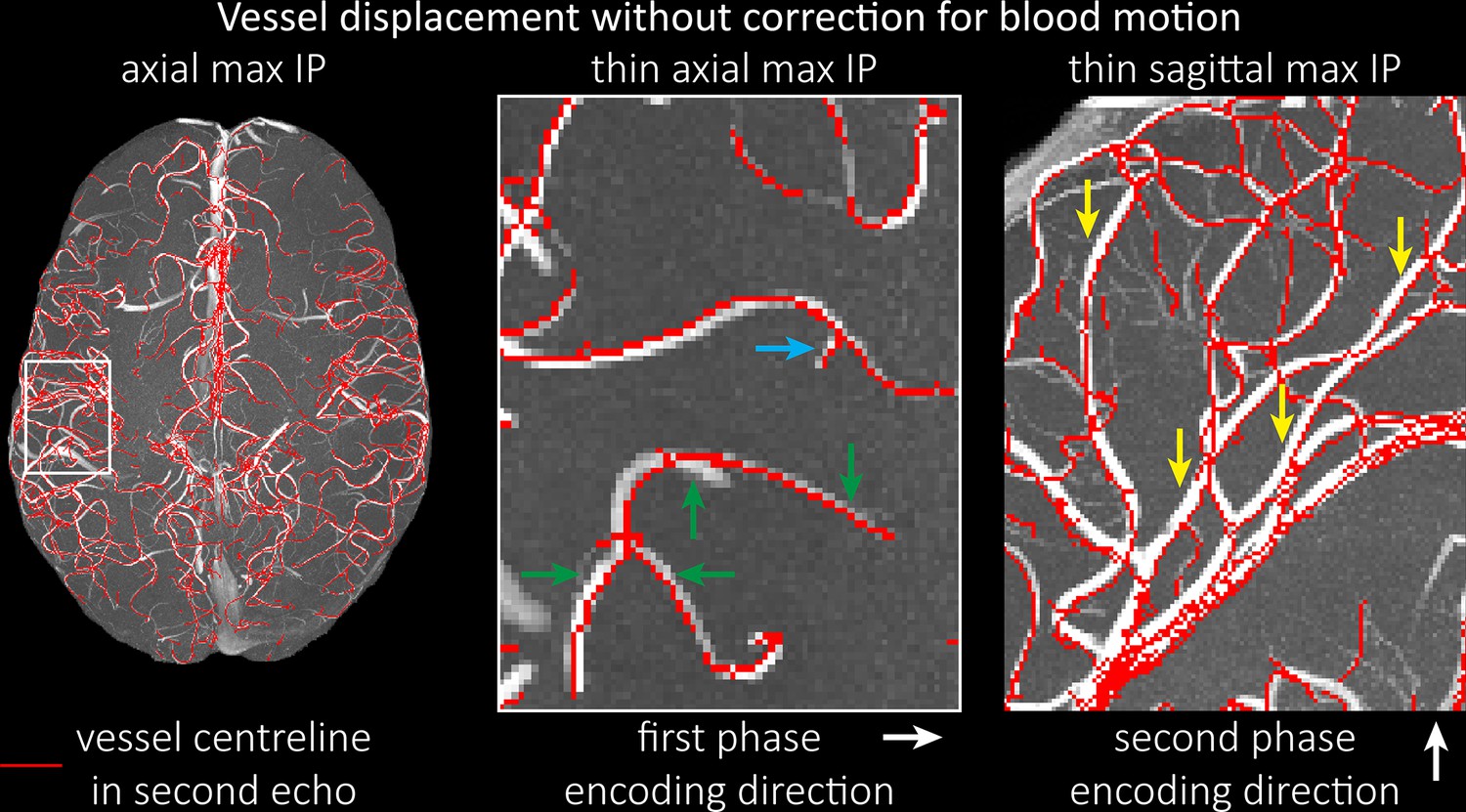 Imaging of the pial arterial vasculature of the human brain in vivo ...