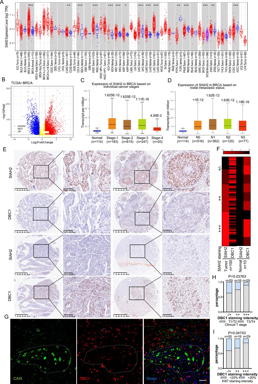 Hypoxia-induced Proteasomal Degradation Of Dbc1 By Siah2 In Breast 