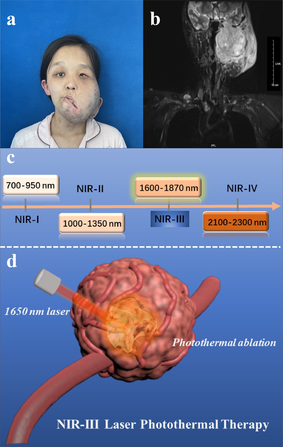 photonic-hyperthermia-of-malignant-peripheral-nerve-sheath-tumors-at