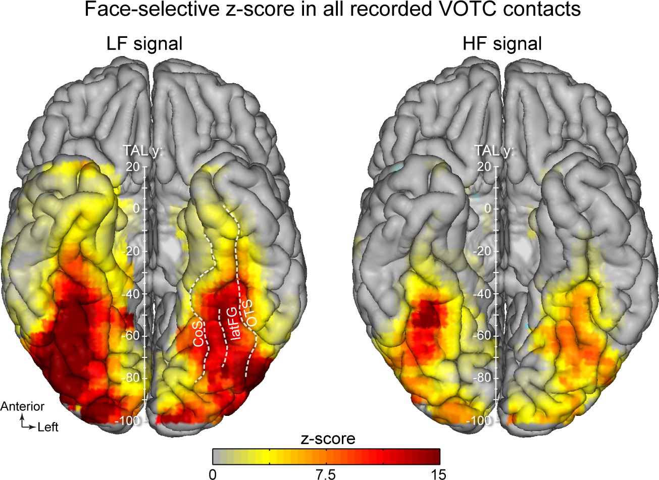 Low and high frequency intracranial neural signals match in