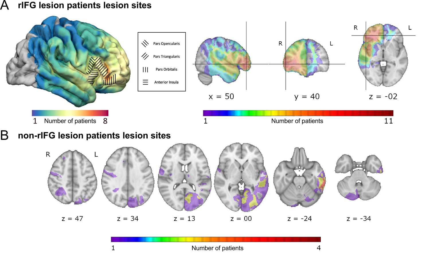 Right inferior frontal gyrus damage is associated with impaired initiation  of inhibitory control, but not its implementation