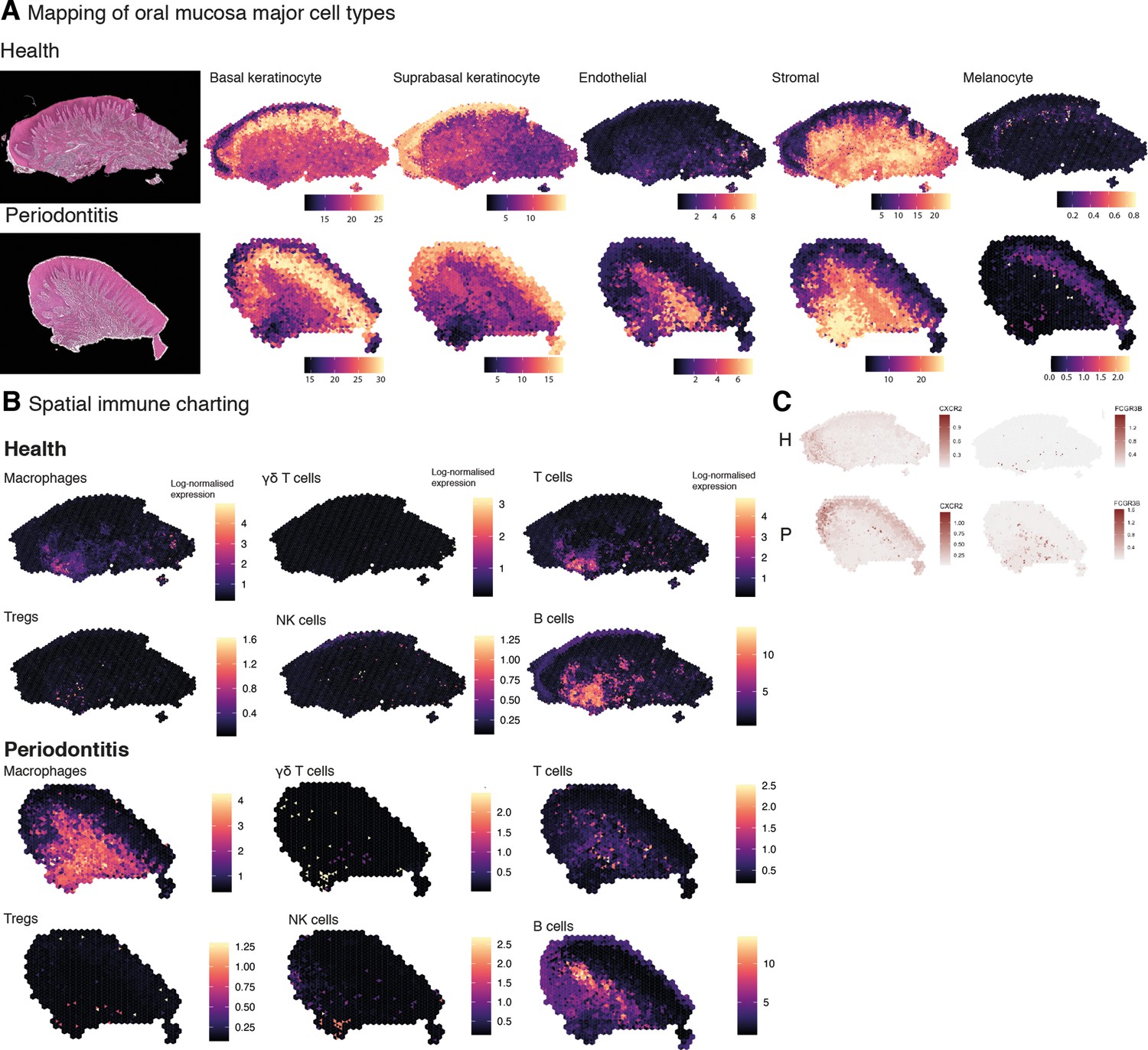 Spatially Resolved Transcriptomics Reveals Pro-inflammatory Fibroblast ...