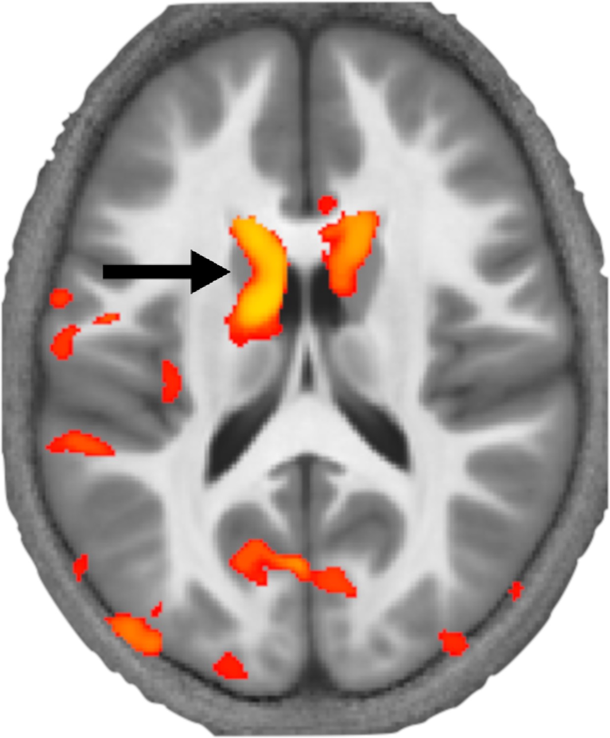 Developmental Language Disorder: What happens in the brain? | eLife