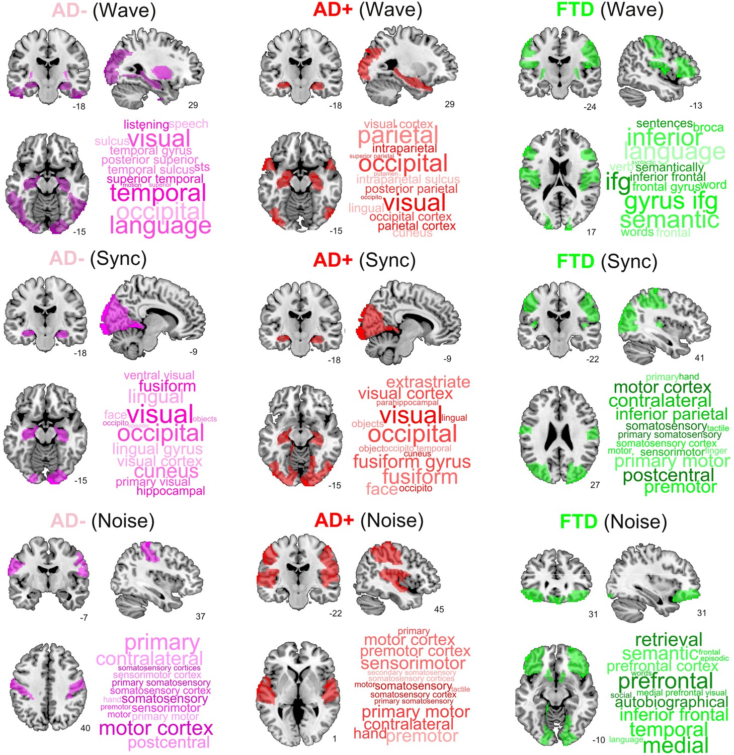 Model-based Whole-brain Perturbational Landscape Of Neurodegenerative ...