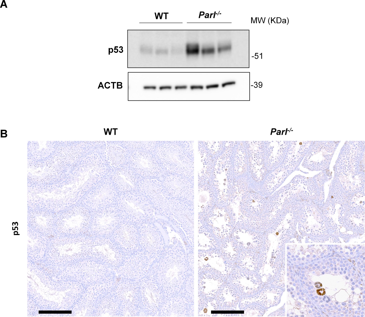 Mitochondrial defects caused by PARL deficiency lead to arrested  spermatogenesis and ferroptosis